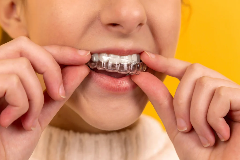 An image of a child placing clear Invisalign aligners onto their teeth, showing how Invisalign works for kids