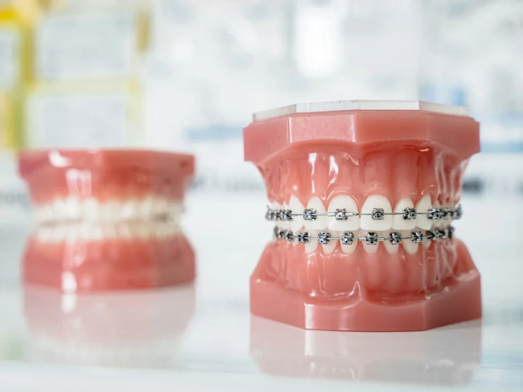 An image of a dental model with traditional metal braces, showing brackets and wires used to straighten teeth.